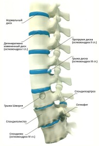 остеохондроз