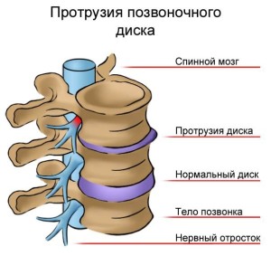 протрузия