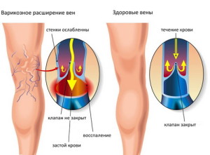 варикоз_1